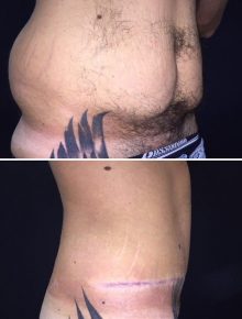 Addominoplastica e liposuzione fianchi uomo prima dopo laterale